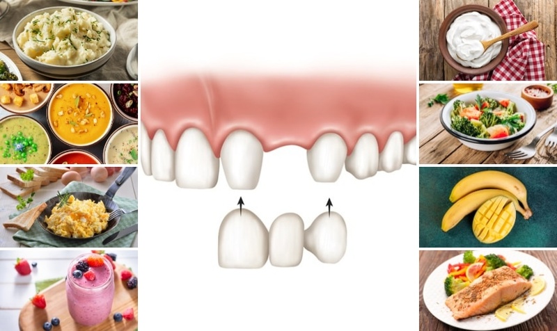 Ăn đồ ăn mềm lỏng sau khi làm cầu răng sứ