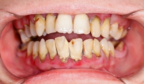 cao răng