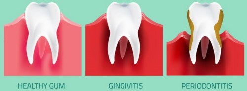 bị viêm nướu răng mãn tính có chữa khỏi được không