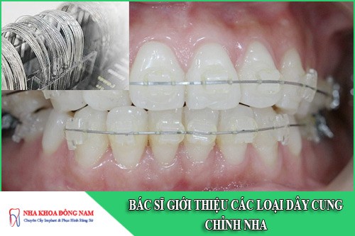 các loại dây cung chỉnh nha