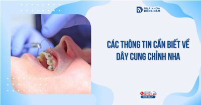 Các thông tin cần biết về dây cung chỉnh nha