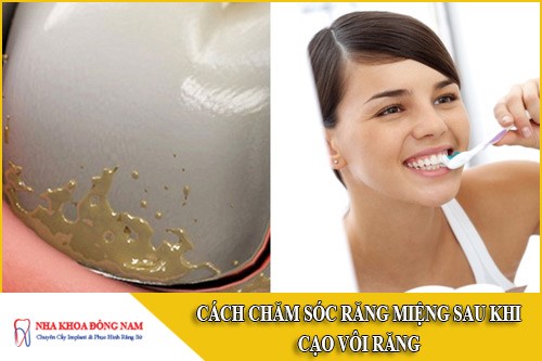 cách chăm sóc răng miệng sau khi cạo vôi răng