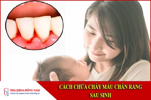 cách chữa chảy máu chân răng sau sinh