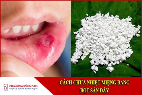 cách chữa nhiệt miệng bằng bột sắn dây
