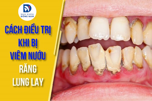 cách điều trị khi bị viêm nướu răng lung lay