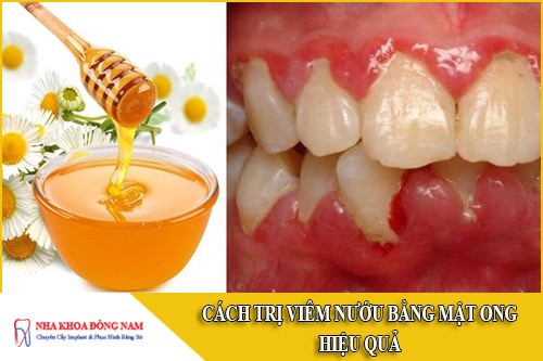 cách trị viêm nướu bằng mật ong