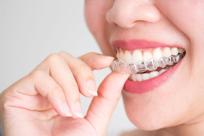 Đeo máng chống nghiến nếu có tật nghiến răng khi ngủ