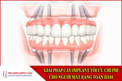 Giải pháp cấy Implant tối ưu chi phí cho người mất răng toàn hàm
