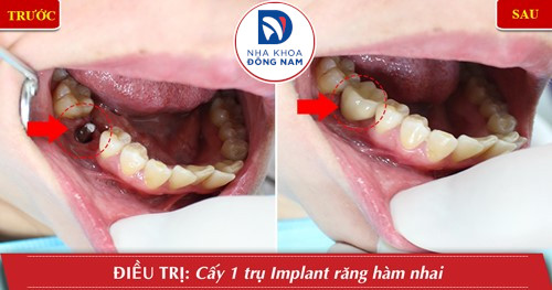 trồng implant răng số 6