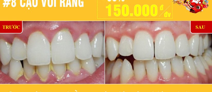 Nha khoa đông nam khuyến mãi cạo vôi răng nhân dịp noel và tết tây 2019