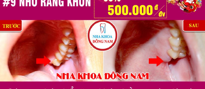 Khuyến mãi Nhổ răng khôn nhân dịp noel và tết tây 2019