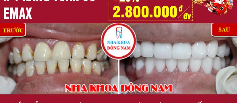 Khuyến mãi răng toàn sứ Emax nhân dịp noel và tết tây 2019
