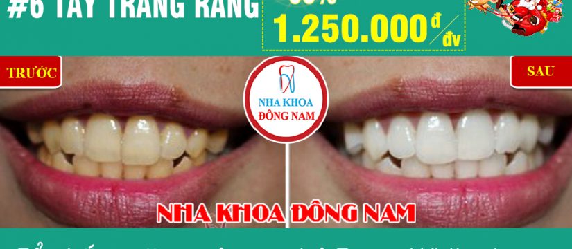 Khuyến mãi tẩy trắng răng nhân dịp noel và tết tây 2019