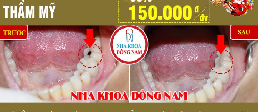 Khuyến mãi trám răng nhân dịp noel và tết tây 2019