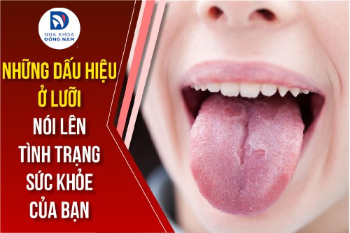 Những nguyên nhân nào gây ra bệnh lưỡi trắng?
