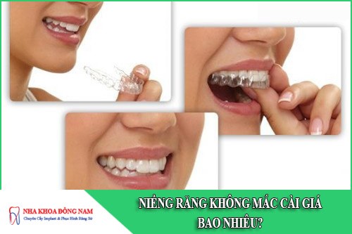 niềng răng không mắc cài giá bao nhiêu