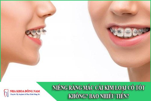 niềng răng mắc cài kim loại có tốt không