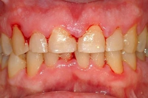 sâu răng viêm nướu