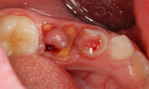 sâu răng viêm tủy
