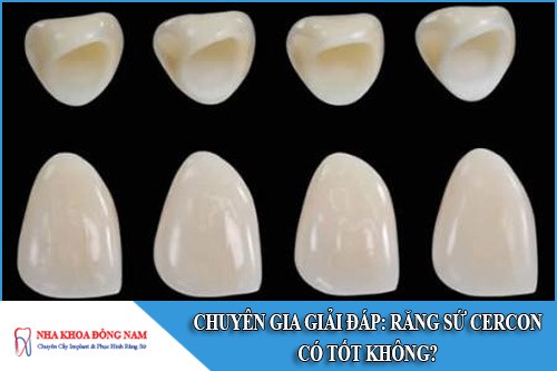 răng sứ cercon có tốt không