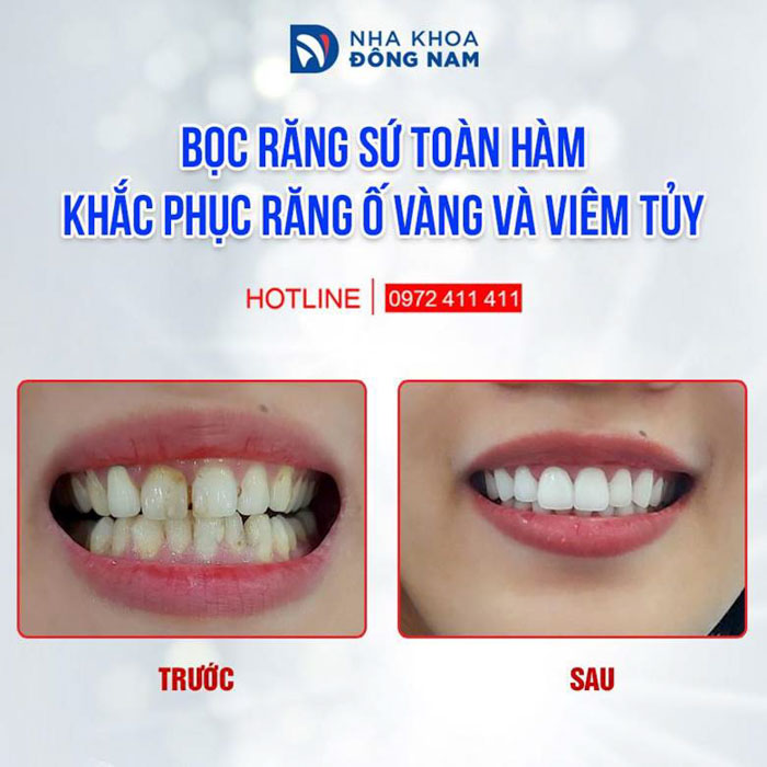 Răng viêm tủy nên thực hiện bọc răng sứ để khắc phục hiệu quả