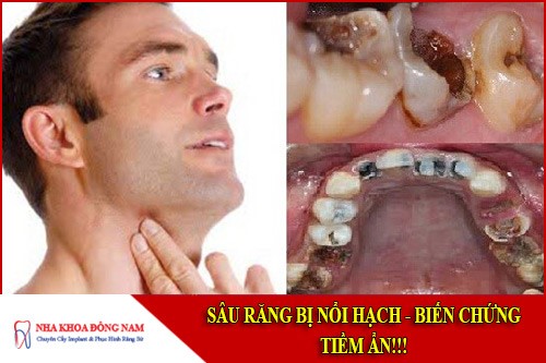 sâu răng bị nổi hạch