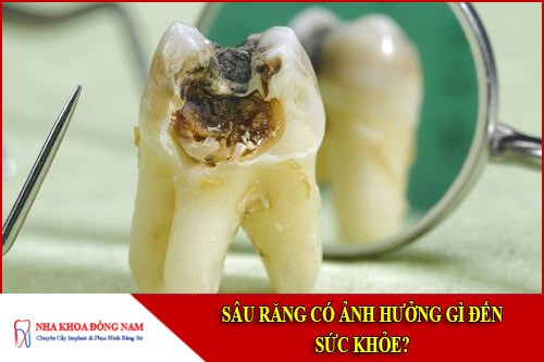 sâu răng có ảnh hưởng gì đến sức khỏe