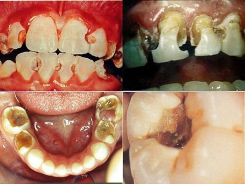 tác hại của sâu răng