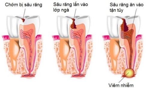 diễn biến của sâu răng