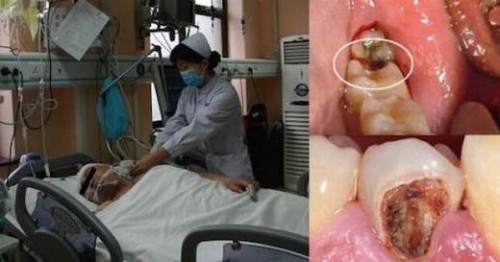 sâu răng dẫn đến chết người ở trung quốc