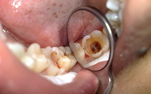 Sâu răng phá hủy toàn bộ cấu trúc răng