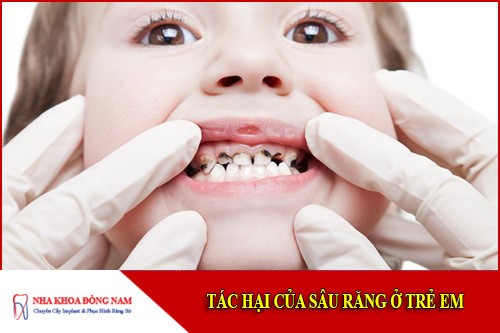 tác hại của sâu răng ở trẻ em