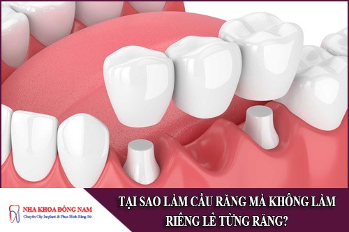 Tại sao làm cầu răng mà không làm riêng lẻ từng răng