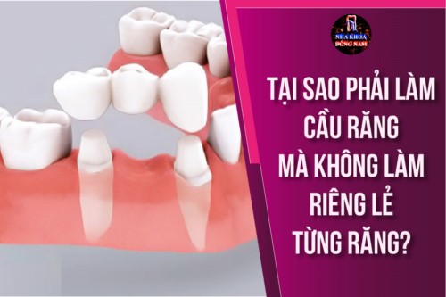 Tại sao làm cầu răng mà không làm riêng lẻ từng răng