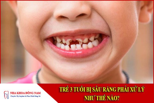 trẻ 3 tuổi bị sâu răng phải xử lý thế nào