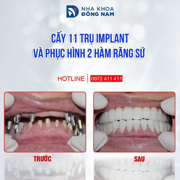 Trồng răng giả bền đẹp với giải pháp cấy ghép Implant hiện đại