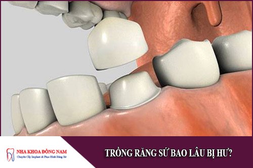 trồng răng sứ bao lâu bị hư