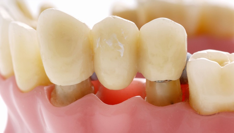 Vệ sinh cầu răng sứ khó hơn bọc từng chiếc răng sứ riêng lẻ