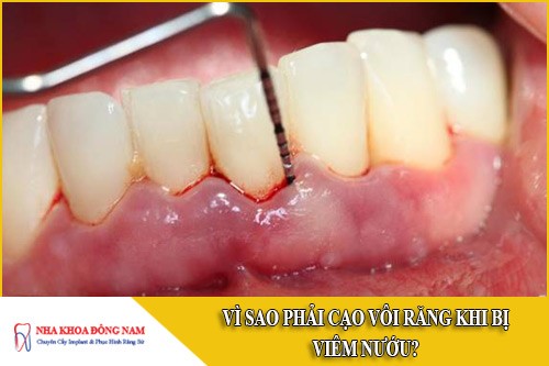 vì sao phải cạo vôi răng khi bị viêm nướu