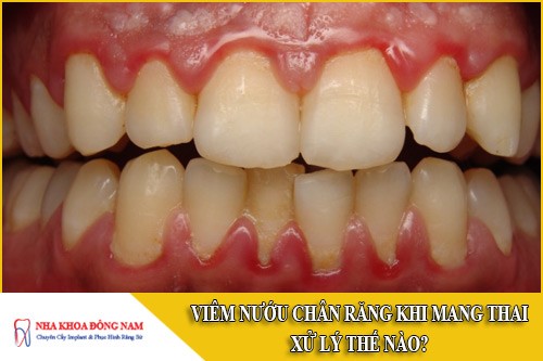 viêm nướu chân răng khi mang thai xử lý thế nào