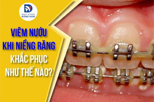 viêm nướu khi niềng răng khắc phục như thế nào
