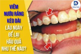 viêm nướu răng kéo dài lâu ngày để lại hậu quả như thế nào
