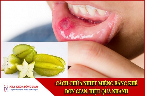 cách chữa nhiệt miệng bằng khế