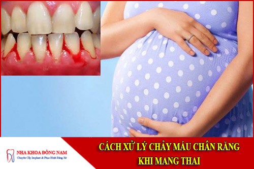cách xử lý chảy máu chân răng khi mang thai