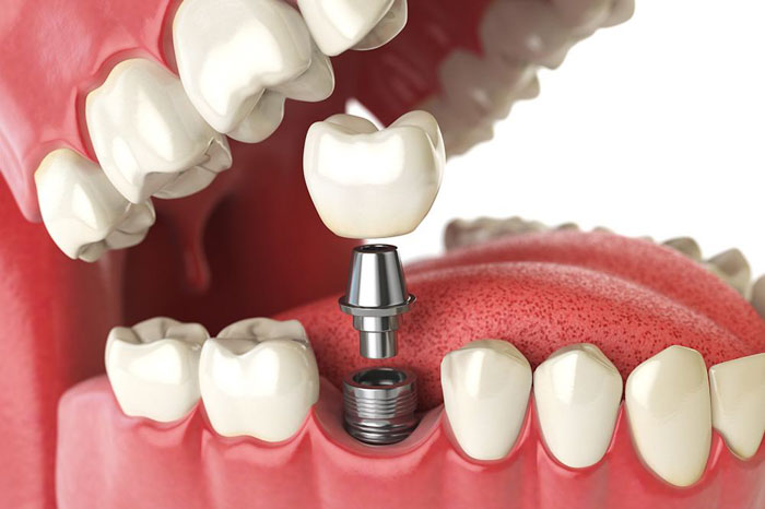 Cấy ghép Implant giúp khôi phục đầy đủ thân và chân răng