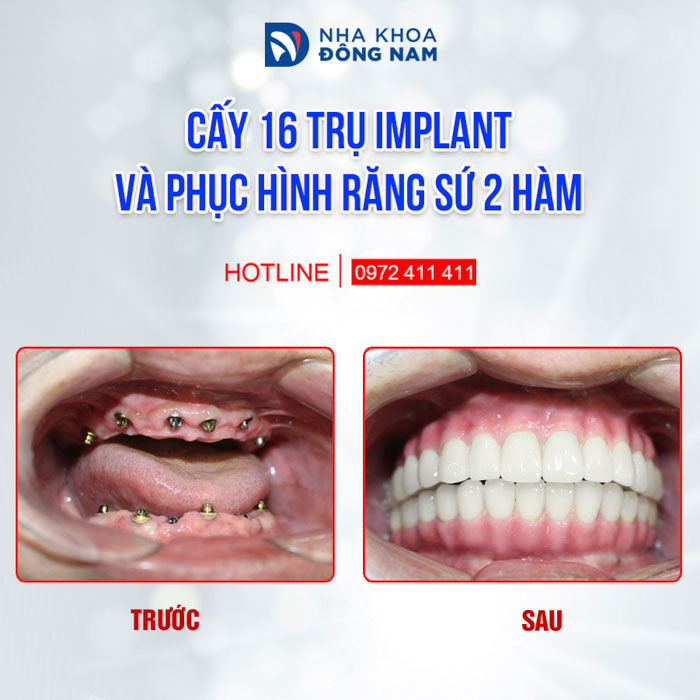 Cấy ghép Implant giúp phục hình răng mất tốt nhất hiện nay