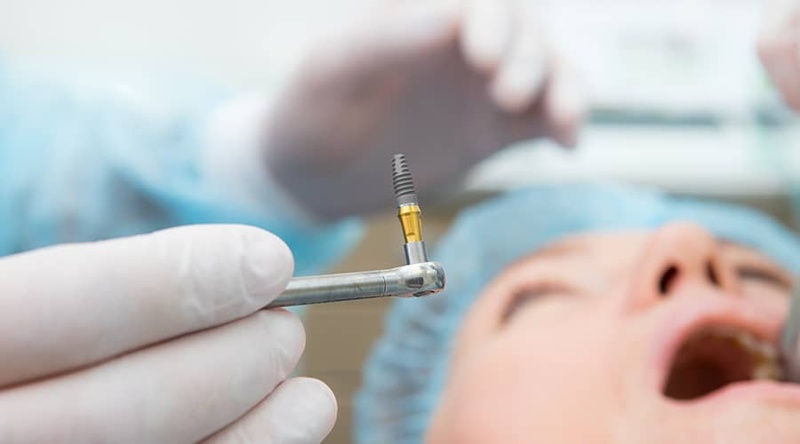 Cấy ghép Implant là kỹ thuật đỉnh cao trong nha khoa hiện đại