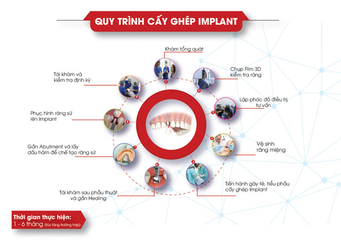 Cấy ghép Implant mất tầm 1 – 6 tháng tùy từng trường hợp