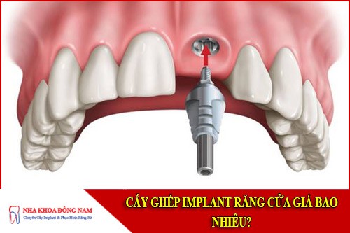 cấy ghép implant răng cửa giá bao nhiêu