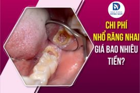 chi phí nhổ răng nhai giá bao nhiêu tiền